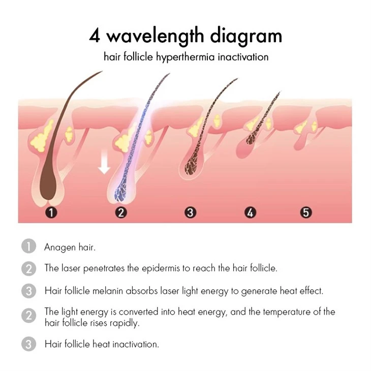 Reasons To Choose Soprano Titanium Laser Hair Removal Machine